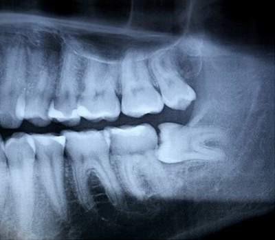 Khi nào nhổ răng khôn mọc lệch? và khi nào không lên nhổ răng khôn?