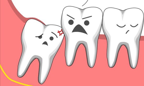 Khi nào nhổ răng khôn mọc lệch? và khi nào không lên nhổ răng khôn? - ảnh 3