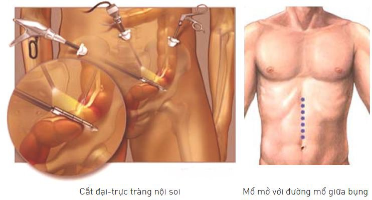 Tìm hiểu kỹ thuật cắt đại tràng phải hoặc cắt đại tràng trái - ảnh 2
