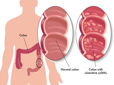 Bệnh Crohn ở trẻ em và thiếu niên - ảnh 1