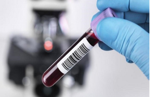 Viêm gan B là bệnh gì? Xét nghiệm máu chẩn đoán Viêm gan B - ảnh 4