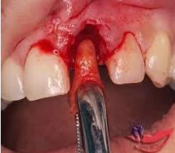 Răng sâu vào tủy là gì?, dấu hiệu nhận biết, các biến chứng, điều trị và Phòng tránh - ảnh 5