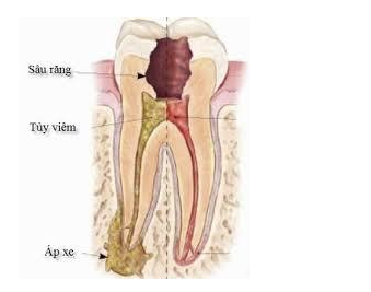 Răng sâu vào tủy là gì?, dấu hiệu nhận biết, các biến chứng, điều trị và Phòng tránh - ảnh 3