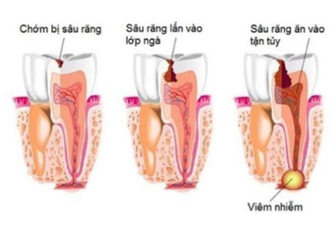 Răng sâu vào tủy là gì?, dấu hiệu nhận biết, các biến chứng, điều trị và Phòng tránh - ảnh 2