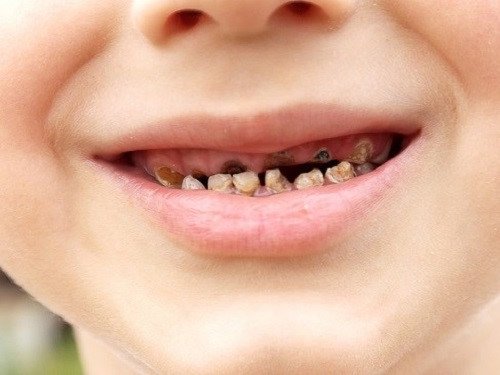 Xiết ăn răng ở trẻ em là gì? Điều trị và Cách phòng ngừa