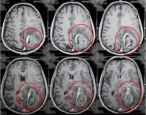 Quy trình chụp cộng hưởng từ sọ não không tiêm thuốc đối quang từ - ảnh 1