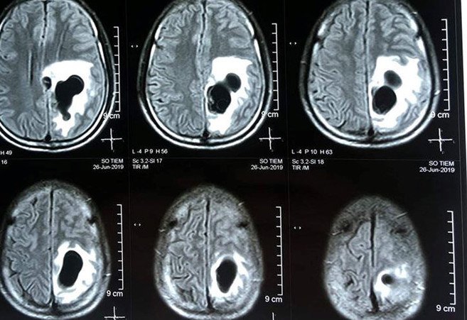 Quy trình chụp cộng hưởng từ sọ não có tiêm thuốc đối quang từ - ảnh 1