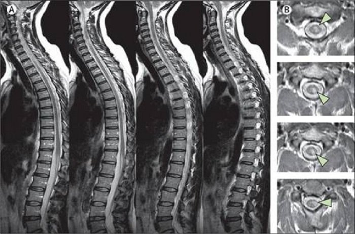 Quy trình chụp cộng hưởng từ cột sống thắt lưng không tiêm thuốc đối quang từ - ảnh 1