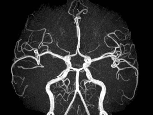 Chụp cộng hưởng từ (MRI) động mạch chủ bụng - ảnh 1
