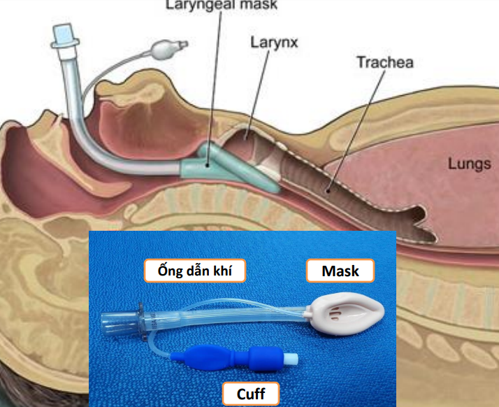 Biến chứng do gây mê mặt nạ thanh quản mổ nội soi cắt gần toàn bộ tuyến giáp trong bệ - ảnh 2