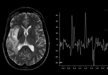 Có nên chụp cộng hưởng từ phổ sọ não để chẩn đoán bệnh sa sút trí tuệ - ảnh 2