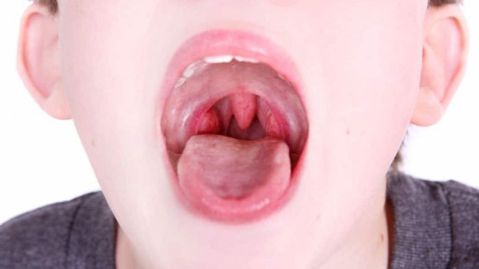 Viêm sưng họng, nổi hạch ở cổ, lưỡi là bệnh gì?