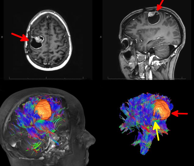 Chụp cộng hưởng từ các bó sợi thần kinh để chẩn đoán bệnh lý u não xâm lấn - ảnh 4