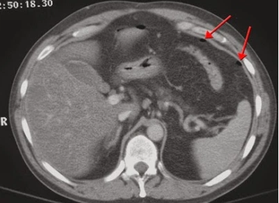 Quy trình chụp CT tầng trên ổ bụng có khảo sát mạch các tạng - ảnh 3