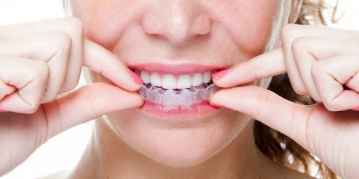 Nguyên nhân gây xỉn màu răng, Các phương pháp tẩy trắng răng và những lưu ý - ảnh 3