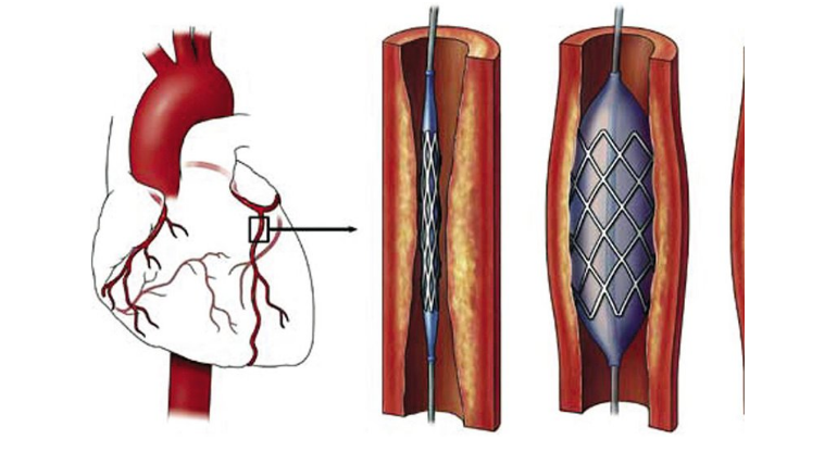 Quy trình chụp cộng hưởng từ động mạch vành - ảnh 1