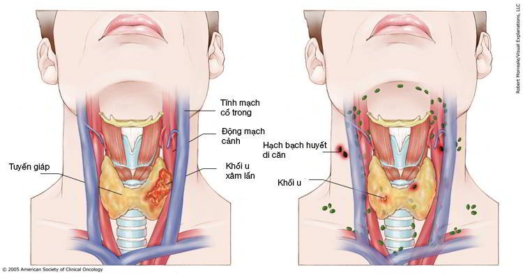 Yếu tố nguy cơ của ung thư vòm họng - ảnh 1