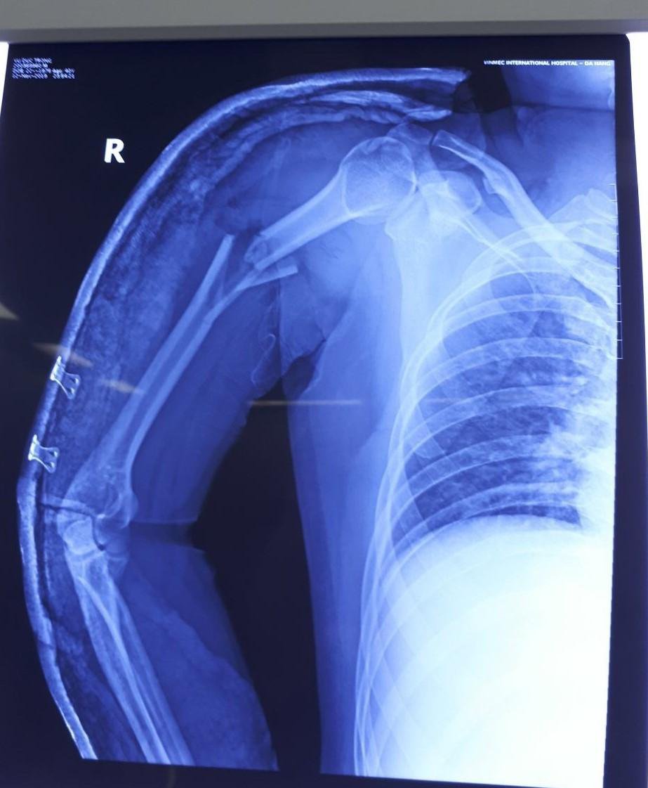 Kỹ thuật chụp X-quang cánh tay thẳng nghiêng:Chuẩn bị, quy trình và Đánh giá kết quả - ảnh 3