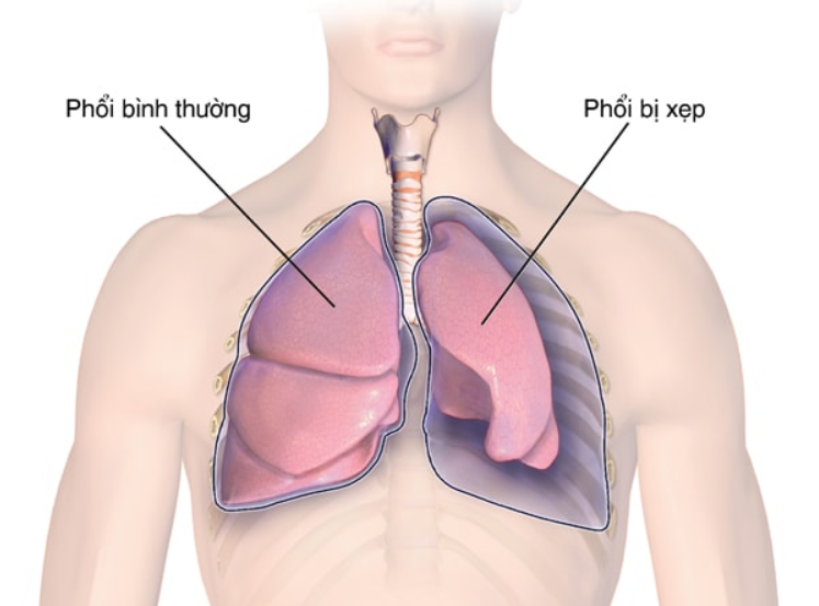 Tăng dự trữ oxy trước khi khởi mê - ảnh 6