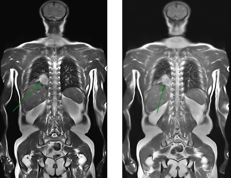 Quy trình chụp cộng hưởng từ động mạch toàn thân có tiêm thuốc đối quang từ - ảnh 3