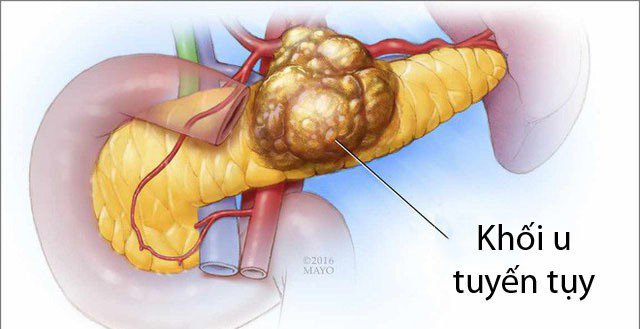 Siêu âm tụy có thể phát hiện dấu hiệu ung thư tuyến tụy không? - ảnh 1