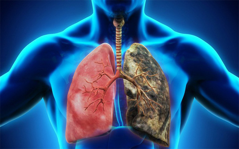 Những yếu tố nguy cơ gây của bệnh ung thư phổi - ảnh 2