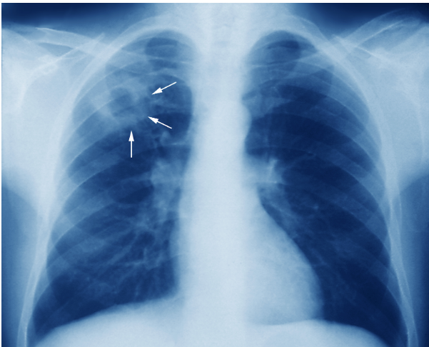 Bệnh phổi kẽ là gì? triệu chứng, các loại bệnh, phương pháp điều trị, phòng ngừa - ảnh 2