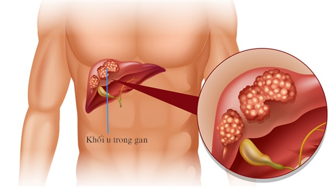 Trước khi siêu âm bụng có được ăn hoặc uống gì không? - ảnh 2