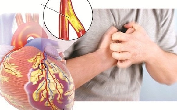 Sự nguy hiểm của Xơ vữa động mạch và tắc nghẽn động mạch - ảnh 4