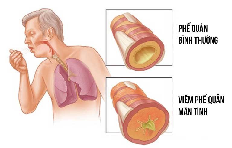 Chụp cắt lớp vi tính định lượng trong bệnh phổi tắc nghẽn mạn tính COPD - ảnh 1