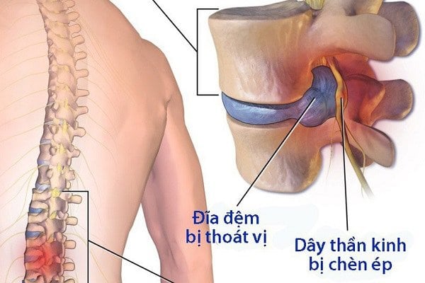 Quy trình chụp cắt lớp vi tính cột sống thắt lưng không tiêm thuốc cản quang - ảnh 2