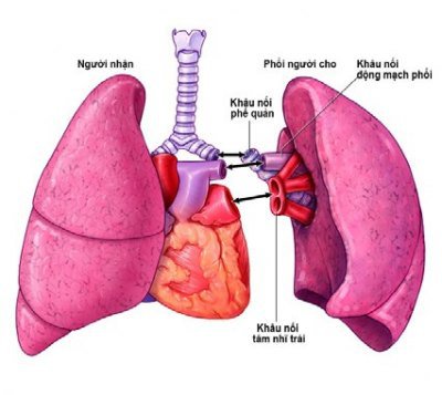 Bệnh phổi kẽ là gì? triệu chứng, các loại bệnh, phương pháp điều trị, phòng ngừa - ảnh 5