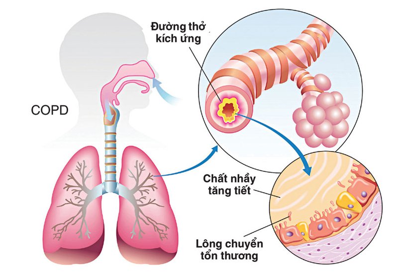 Chụp cắt lớp vi tính định lượng trong bệnh phổi tắc nghẽn mạn tính COPD