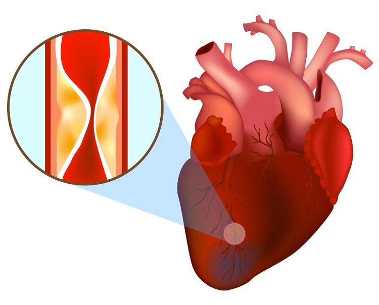 Chụp cộng hưởng từ tim (MRI) đánh giá các bệnh lý tim bẩm sinh - ảnh 2