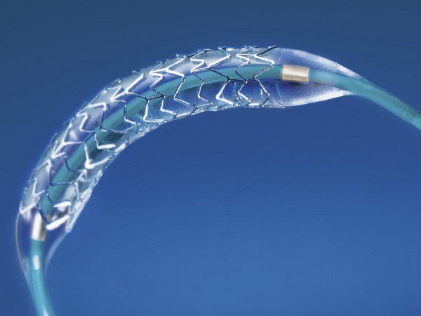 Đặt stent khí – phế quản qua nội soi - ảnh 1