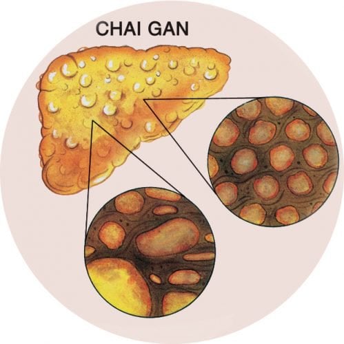 Những điều cần biết về bệnh chai gan - ảnh 1