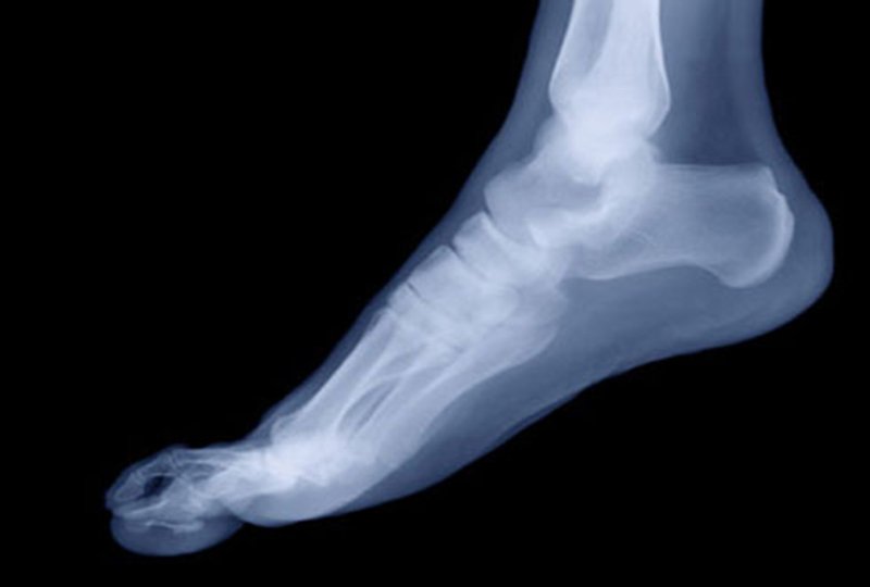 Chụp X- quang xương gót thẳng là gì? Chuẩn bị và Quy trình chụp