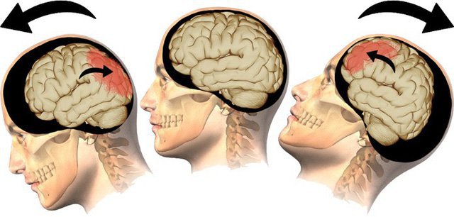 Quy trình Gây mê phẫu thuật cho bệnh nhân chấn thương sọ não - ảnh 1