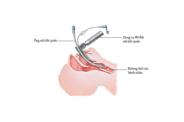 Quy trình Gây mê phẫu thuật cho bệnh nhân chấn thương sọ não - ảnh 2