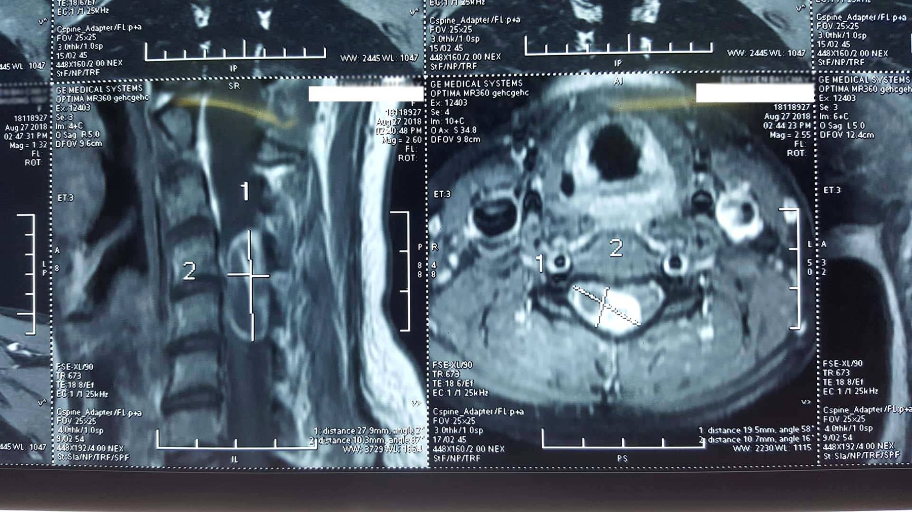 Quy trình chụp cộng hưởng từ cột sống cổ không tiêm thuốc đối quang từ - ảnh 3