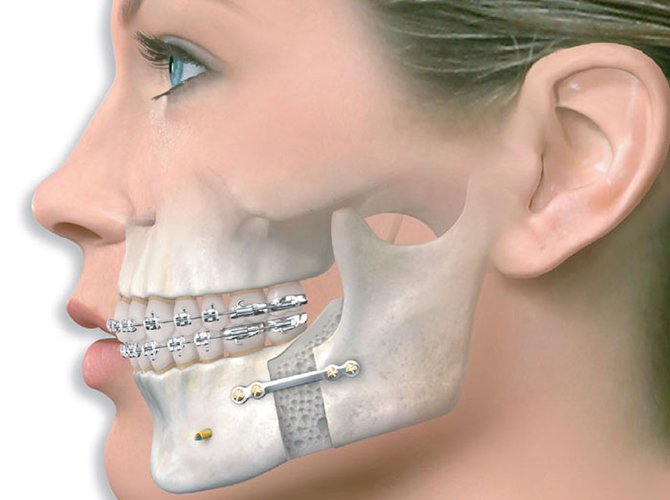 Quy trình chụp cắt lớp vi tính hàm mặt có tiêm thuốc đối quang theo mặt phẳng axial v