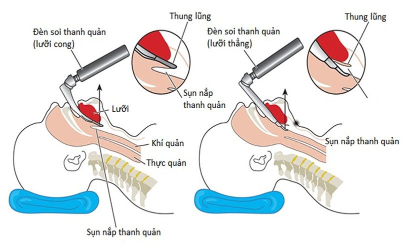 Gây mê nội khí quản phẫu thuật cắt u buồng trứng hoặc bóc u buồng trứng - ảnh 4
