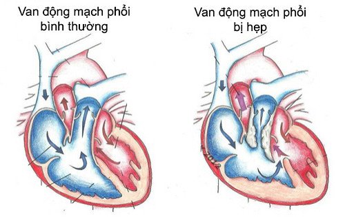 Chỉ định nong hẹp nhánh động mạch phổi - ảnh 1