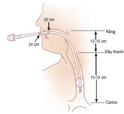 Gây mê nội khí quản phẫu thuật dị dạng tử cung - ảnh 5