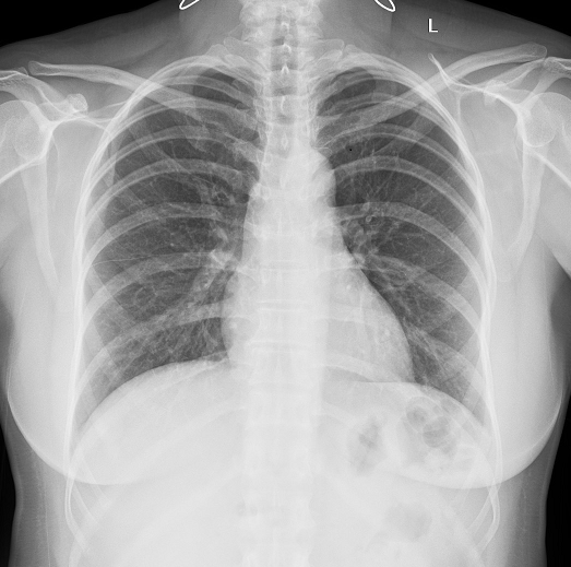 Chẩn đoán hình ảnh lao phổi - ảnh 1