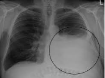 Các bước thực hiện chọc dịch màng phổi cấp cứu - ảnh 1