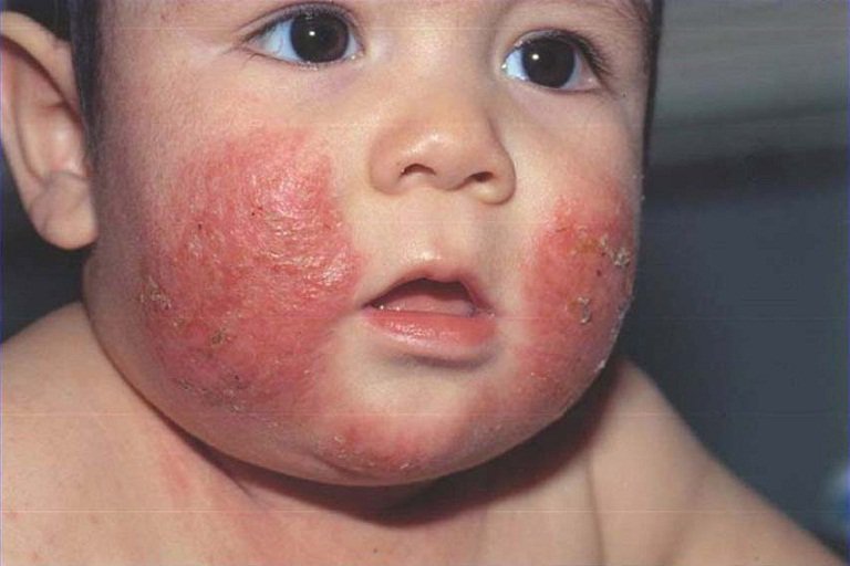 Các dấu hiệu nhận biết trẻ mắc bệnh suy giảm miễn dịch bẩm sinh - ảnh 3