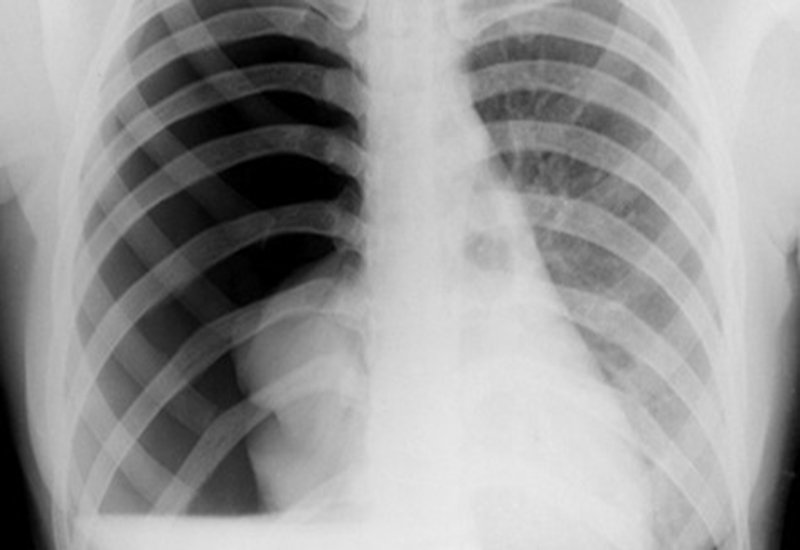 Ứng dụng của siêu âm màng phổi - ảnh 1