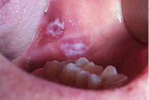 Các yếu tố nguy cơ của ung thư lưỡi - ảnh 1