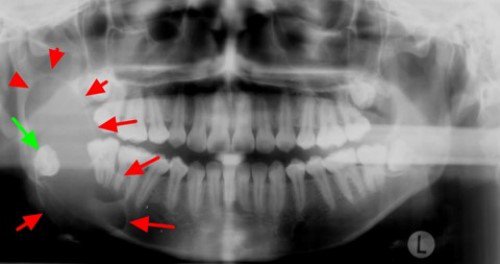 Quy trình chụp X quang răng được thực hiện như thế nào? - ảnh 1